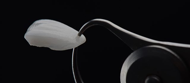 Faccette-dentali-GMTM