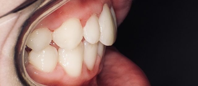 servizi-ortodonzia-del-bambino